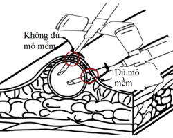 Phình và giả phình đường vào AV