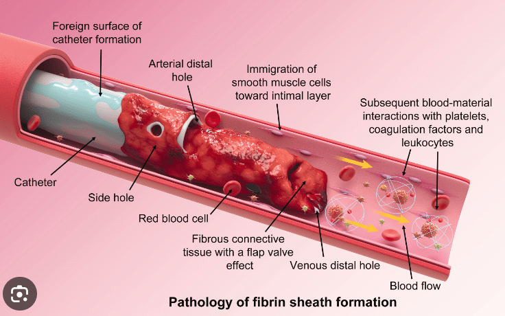 Hình thành tấm fibrin quanh catheter